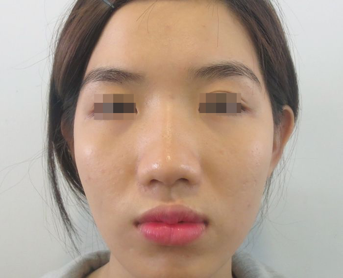 Ghen tị với bạn, cô nàng mũi hếch tìm đến phẫu thuật thẩm mỹ