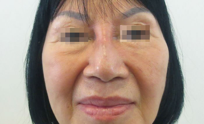 Mũi gồ ghề do phẫu thuật hỏng