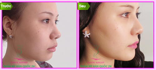 Độn cằm là gì Độn cằm là gì