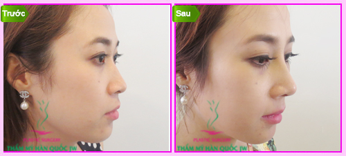 Sửa mũi ở đâu đẹp nhất Sài Gòn