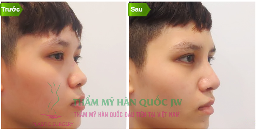 Sửa mũi nam