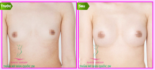 Nâng ngực bằng ánh sáng giá bao nhiêu 
