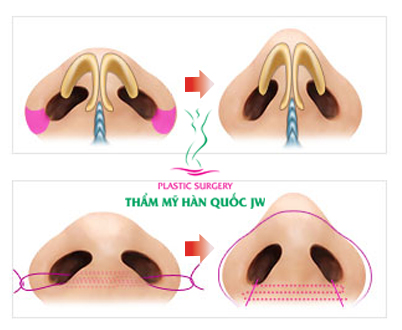 Thu gọn cánh mũi tự nhiên  -1