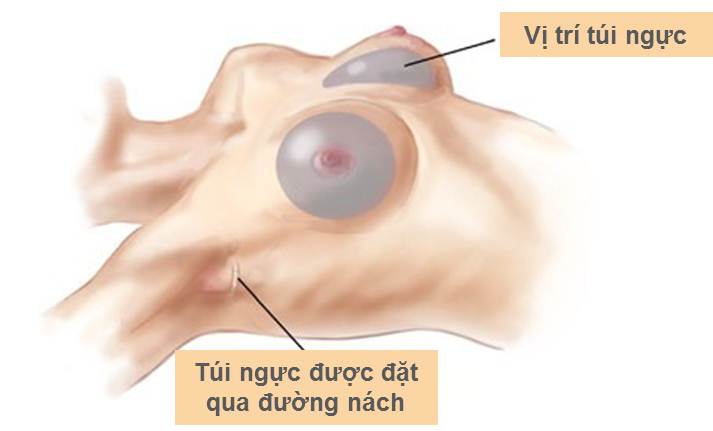 Phương pháp phẫu thuật nâng ngực mới nhất