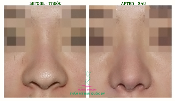 Thu gọn cánh mũi như thế nào Thu gọn cánh mũi như thế nào