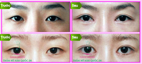 Phẫu thuật bấm mí mắt Hàn Quốc