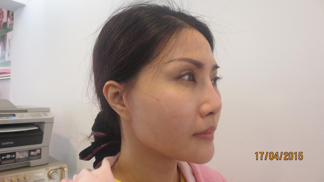 Gương mặt xinh đẹp bất ngờ sau khi sửa mũi hỏng của cô nàng mũi “cà chua”