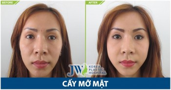 toi-bong-tre-ra-5-tuoi-nho-cay-mo-mat-1