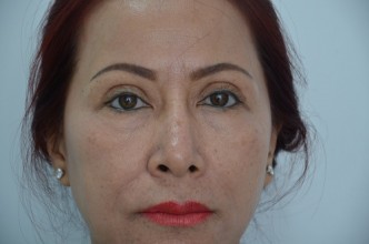 Chấm dứt hơn 20 năm sống chung với mắt phẫu thuật hỏng