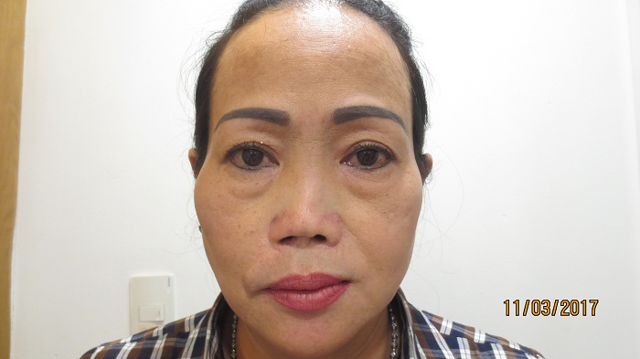 Gương mặt chị Thu Loan sau 9 lần phẫu thuật thẩm mỹ đều thất bại