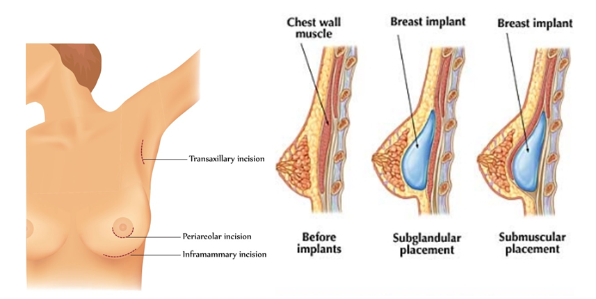 Quá trình đưa túi ngực vào bên trong của phương pháp nội soi