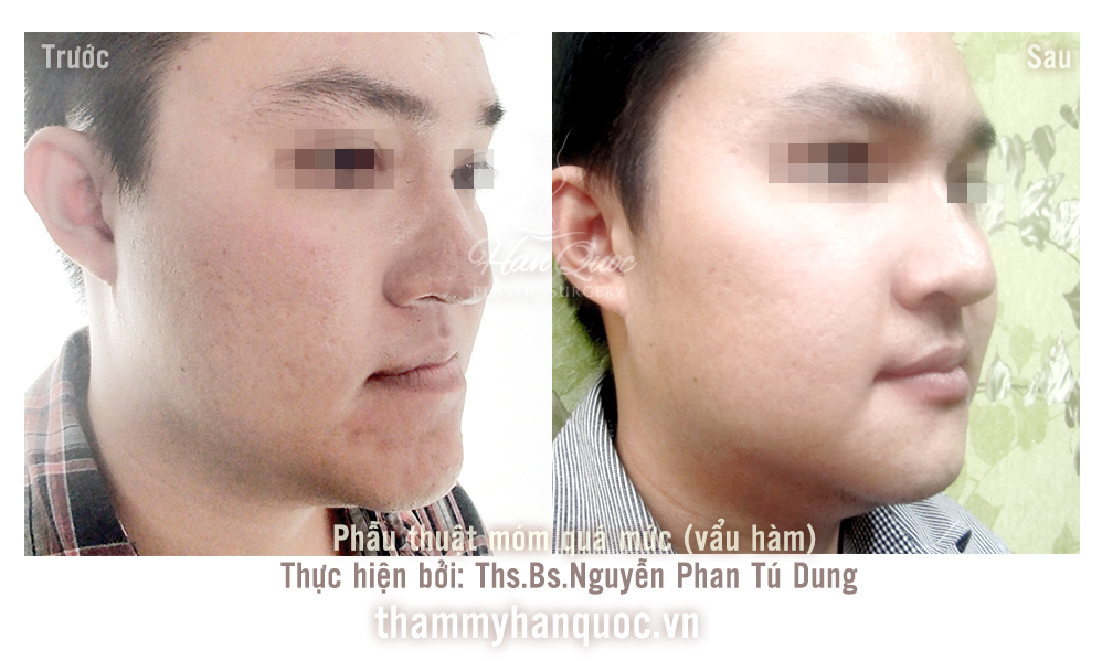 phau-thuat-ho-mom