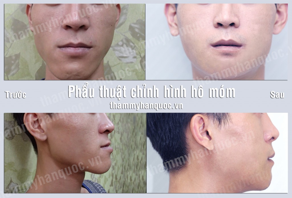 phau-thuat-vau-ham-duoi-1024x695
