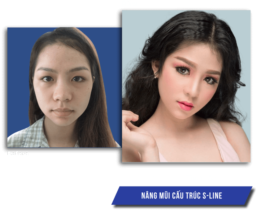 Nâng mũi S Line