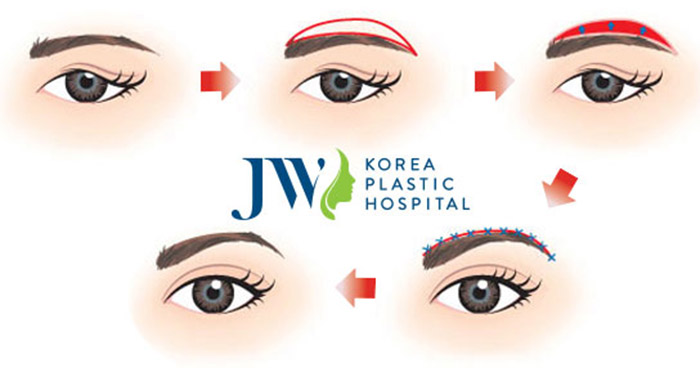 treo cung may co de lai seo hay khong