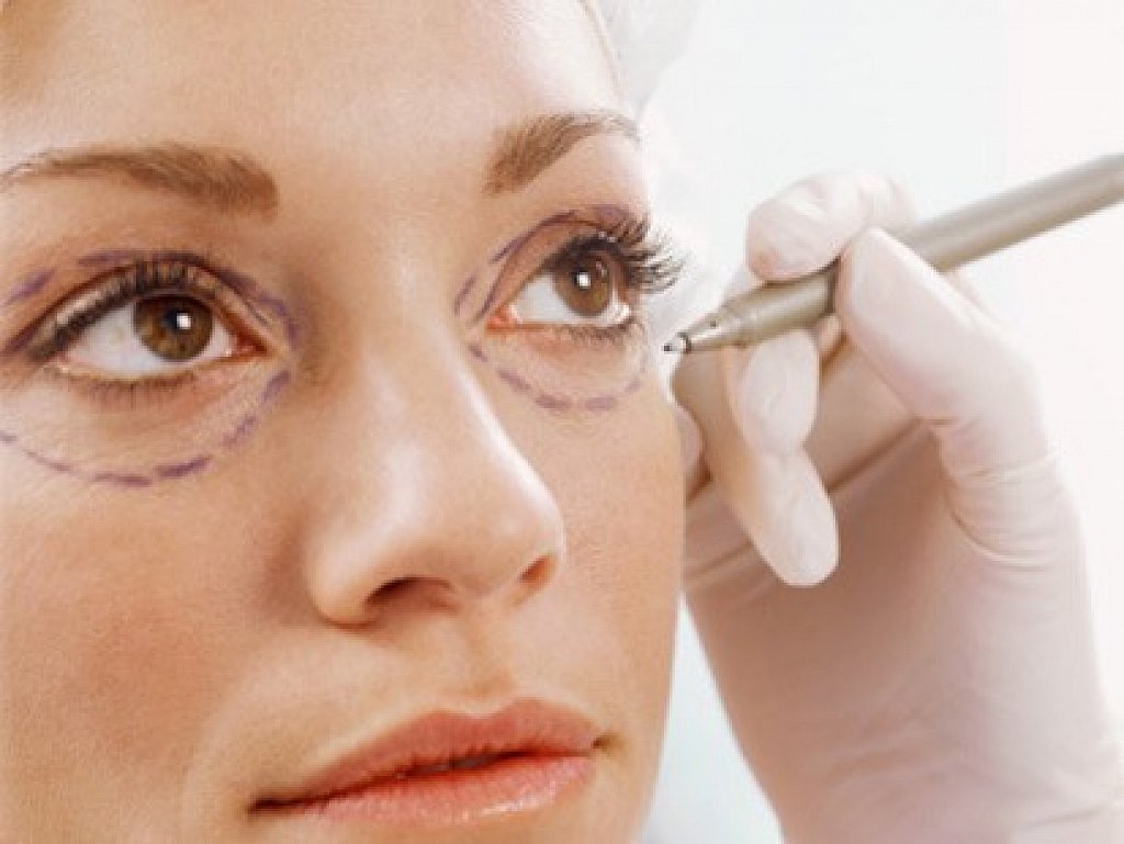 Phẫu thuật Midface làm trẻ hóa vùng mắt 3 trong 1