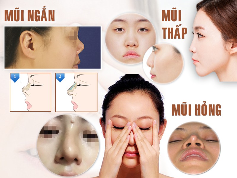 Nâng mũi S Line đẹp tự nhiên với công nghệ chuẩn Hàn - Ảnh 3