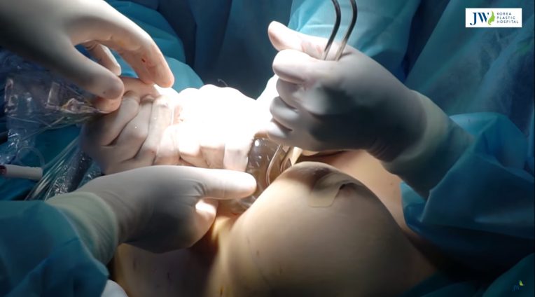 Nâng Ngực Nội Soi - Bí quyết mang lại vòng 1 lý tưởng - Ảnh 4