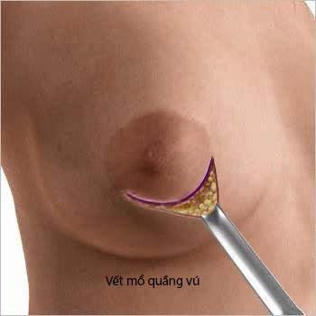 phẫu thuật hút mỡ ngực -1 