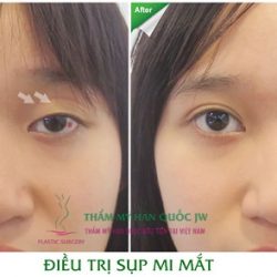 Bất ngờ với vẻ đẹp mới sau ca thẩm mỹ mắt sụp mi khó