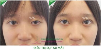 Bất ngờ với vẻ đẹp mới sau ca thẩm mỹ mắt sụp mi khó