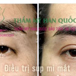 Nhật ký “giải cứu cửa sổ tâm hồn” của anh chàng sụp mi bẩm sinh