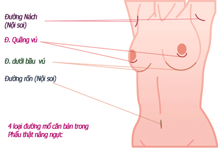 đường mổ trong phẫu thuật nâng ngực