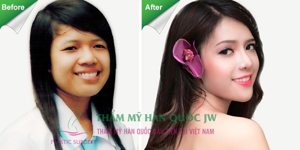 Sửa mũi Hàn Quốc webtretho