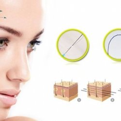 Căng da mặt bằng chỉ collagen giá bao nhiêu?