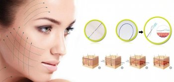 Căng da mặt bằng chỉ collagen giá bao nhiêu?