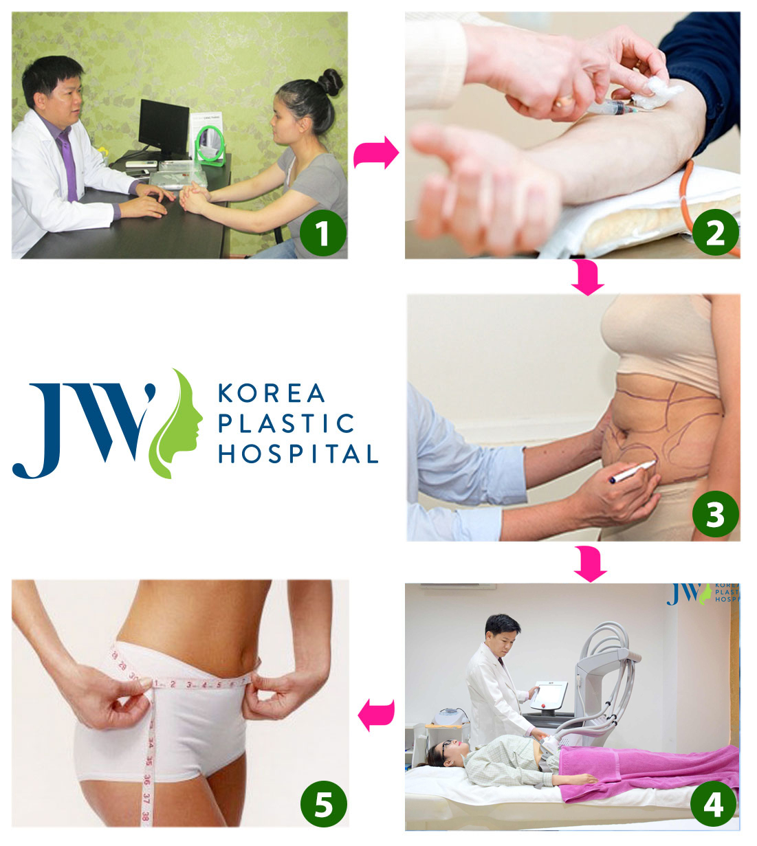 quy trình hút mỡ bụng, quy trình hút mỡ bụng tại JW