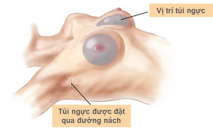 Chi phí thẩm mỹ nâng ngực nội soi