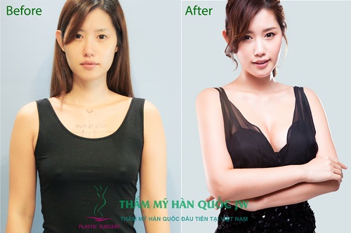 Nâng ngực giá cả