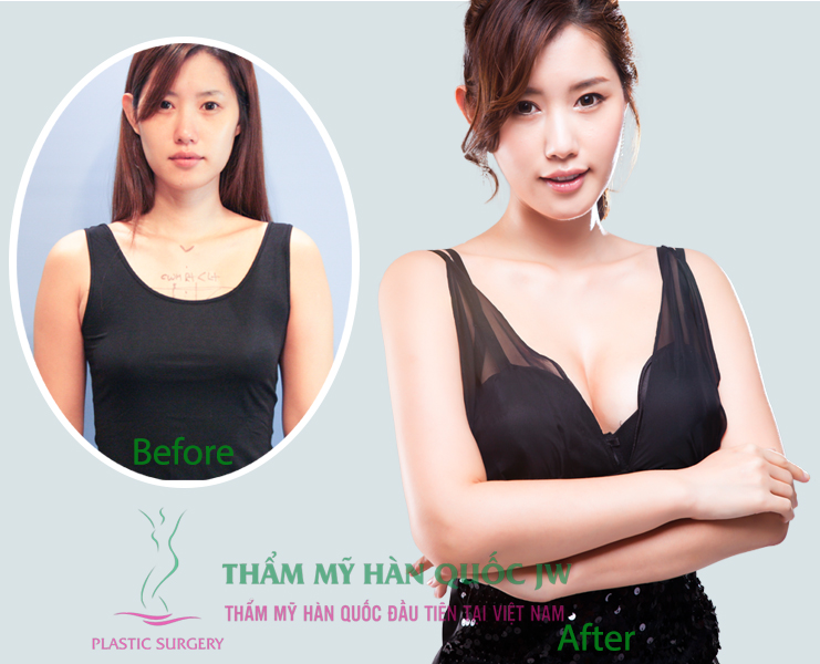 Phẫu thuật thẩm mỹ ngực