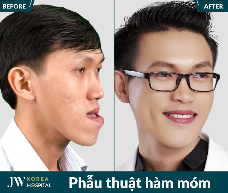 Hàm móm do xương nếu không điều trị đúng có thể ảnh hưởng chức năng ăn nhai và thẩm mỹ gương mặt.