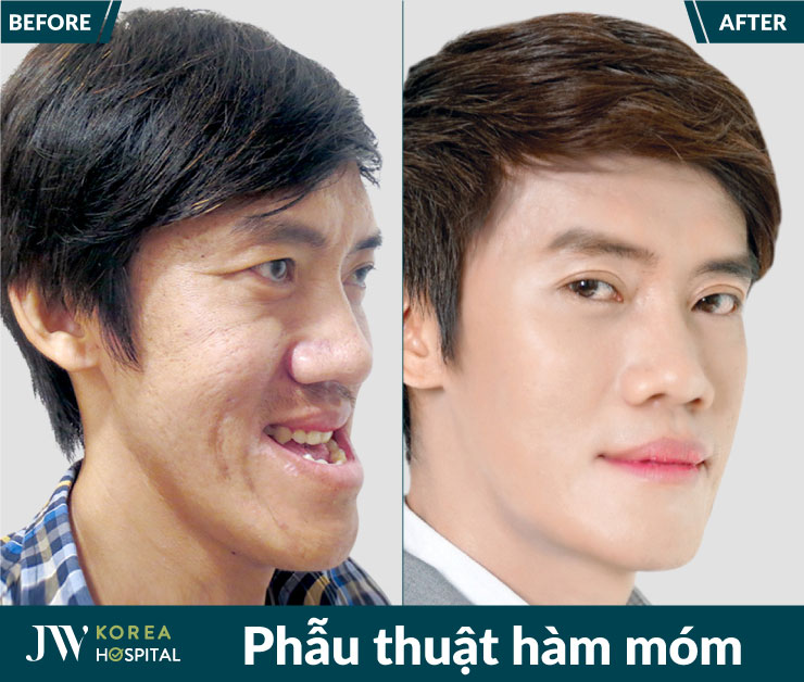 Tại JW, phẫu thuật hàm móm được thực hiện dựa trên thăm khám lâm sàng và chẩn đoán hình ảnh chuyên sâu.