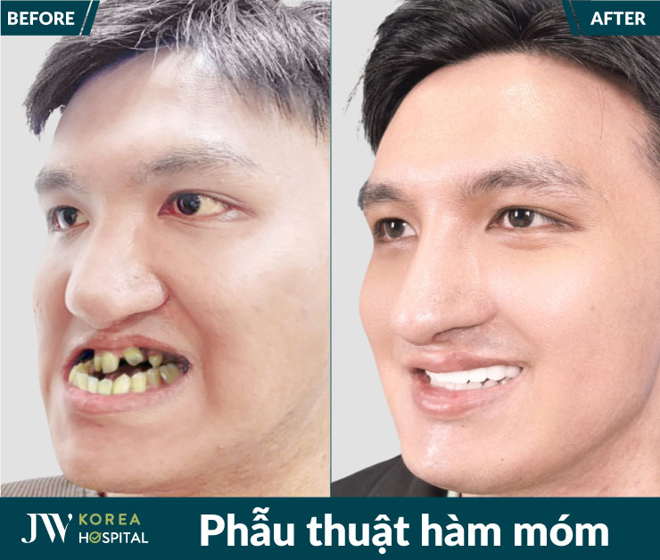 Phẫu thuật hàm móm là giải pháp điều trị hiệu quả cho các trường hợp móm do xương hàm.