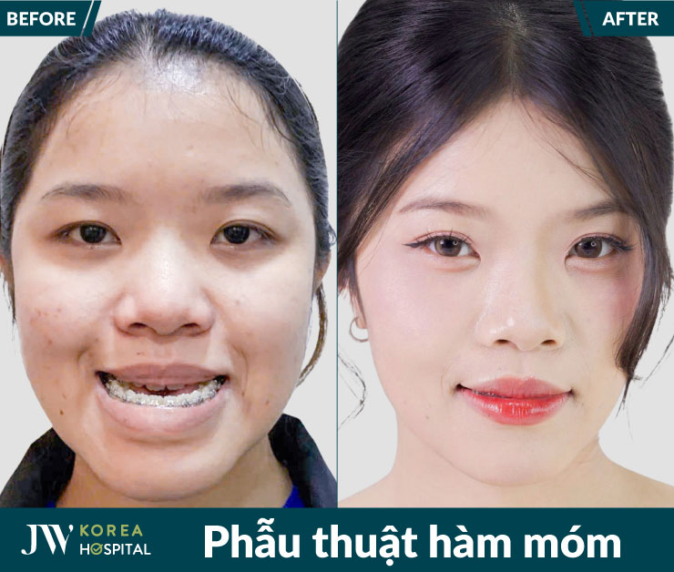 Sau điều trị hàm móm, chức năng phát âm và nhai cắn của người bệnh được cải thiện rõ rệt.