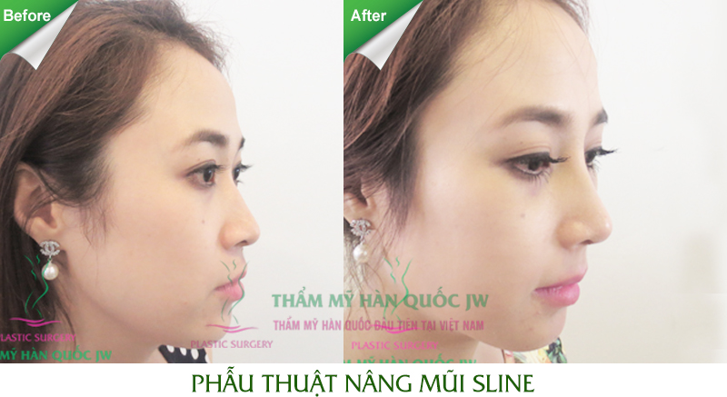 Clip nâng mũi Hàn Quốc