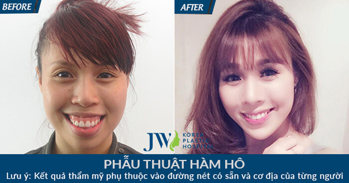 Lan Nhi - Diễn viên múa từng bị hô hàm kèm hở lợi được phẫu thuật thành công tại JW nhờ kỹ thuật cắt Lefort I