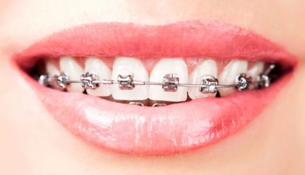 Không phải lúc nào sử dụng niềng răng cũng mang lại kết quả như mong đợi