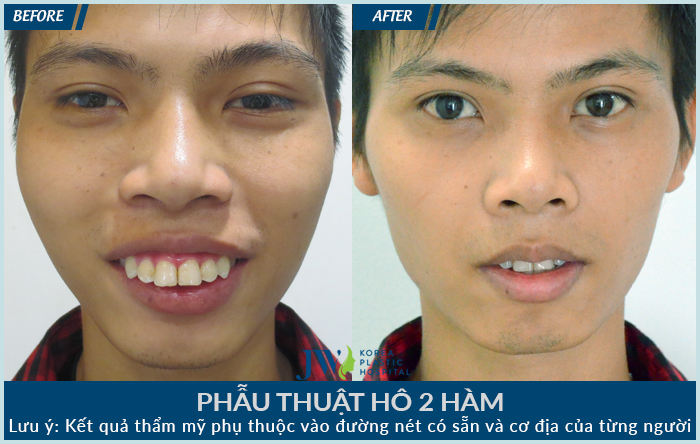 Khách hàng vừa bị hô ở cả 2 hàm kèm hở lơi được khắc phục thành công tại Bệnh viện thẩm mỹ JW Hàn Quốc