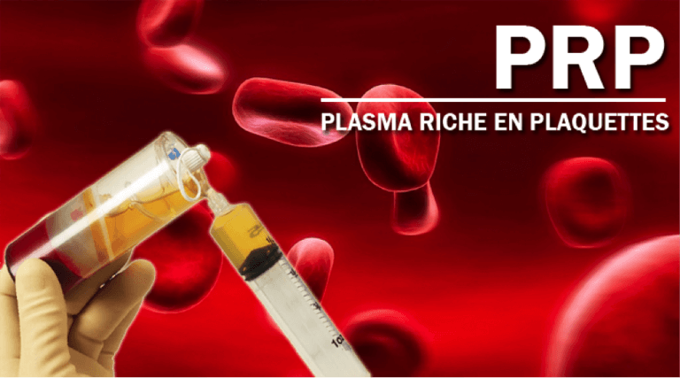 S-line plus rhinoplasty of coating the implant with Platelet Rich Plasma (PRP)