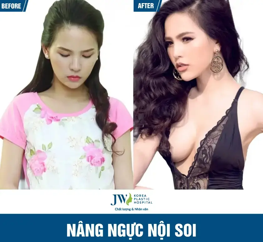 nang-nguc-noi-soi-03-three-benh-vien-jw