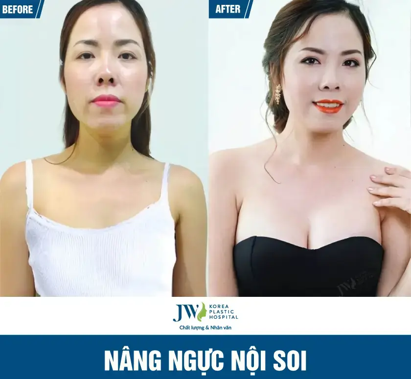 nang-nguc-noi-soi-05-benh-vien-jw