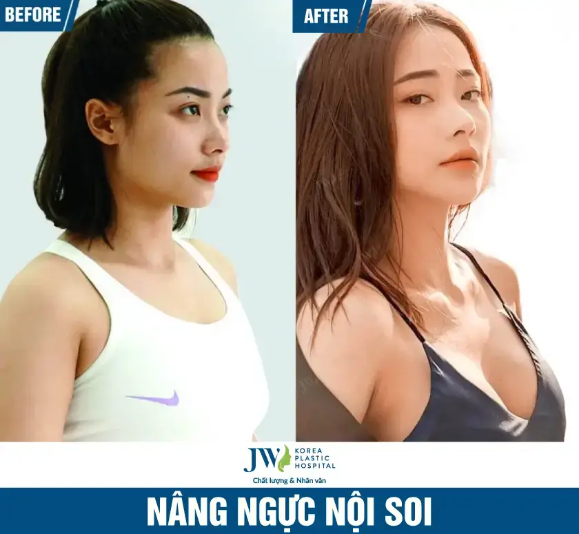 nang-nguc-noi-soi-benh-vien-jw