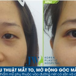 Ngẩn ngơ trước đôi mắt trong veo sau phẫu thuật mắt to