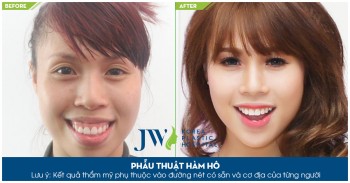 Hàm hô là gì