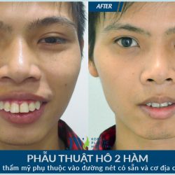 Hình ảnh phẫu thuật hàm hô đẹp nhất tại Thẩm mỹ Hàn Quốc JW