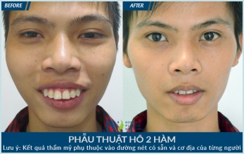 Hình ảnh phẫu thuật hàm hô đẹp nhất tại Thẩm mỹ Hàn Quốc JW